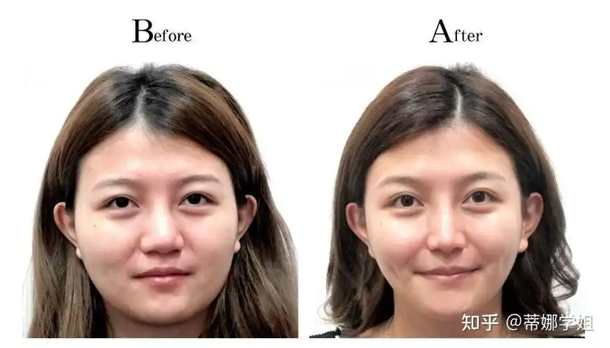 磨骨怎么做才最安全全国顶级磨骨大佬推荐下颌角颧骨正颌攻略