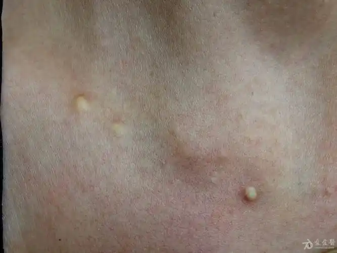 2016年皮肤版有奖病例猜答(11)答案:表皮囊肿.