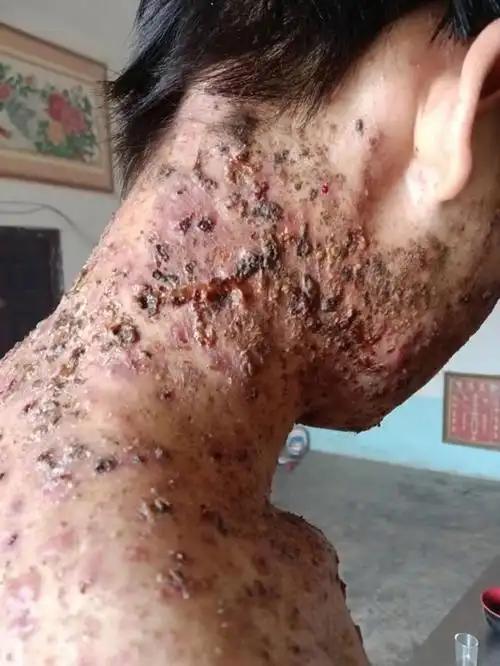 马拉色菌,马拉色菌毛囊炎