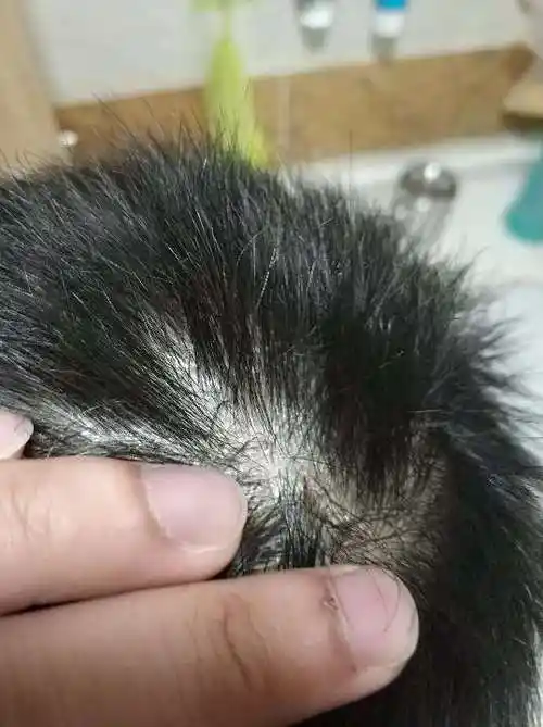 头皮上有一块一块的结疤白色和黄色扣掉后那块头皮是红色的