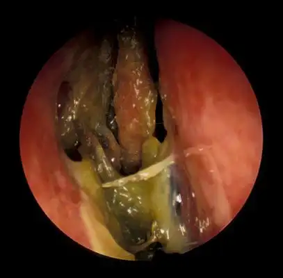 鼻窦炎症状图片 (44)