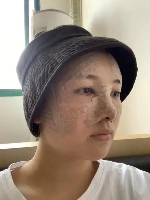 自体脂肪填充全脸第三天;刚做完那会肿胀是真的严重,现在已经好了很多