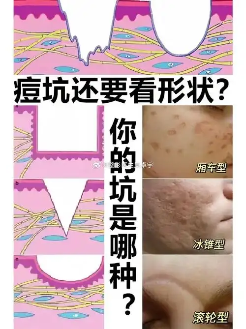 痘坑##上微博学变美##痘坑痘印##痘疤