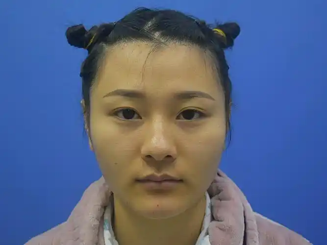 做完下颌角手术两个月啦,改变真的很大哦,之前的宽脸_圈子-新氧美容