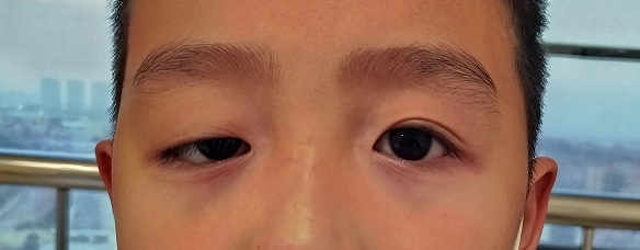 上睑下垂矫正有什么好处和不足?