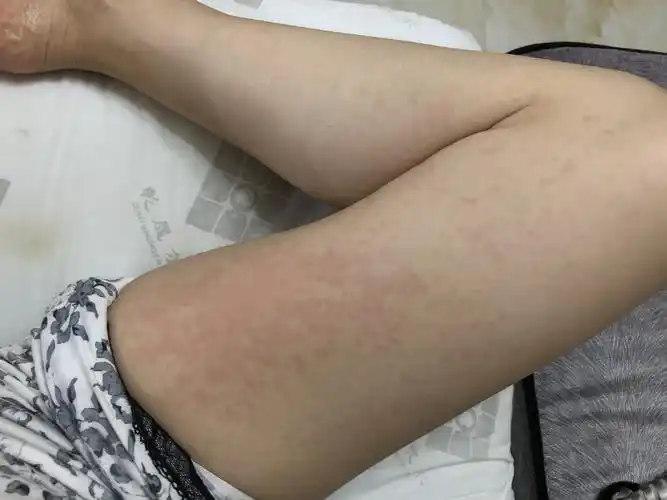 腿上起这好多红疹子,这是怎么了?怎么治疗啊