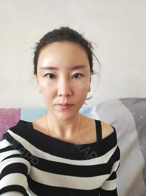 十五天了还那样  泪沟处多了一道棱  苹果肌跑偏了 法令纹出现