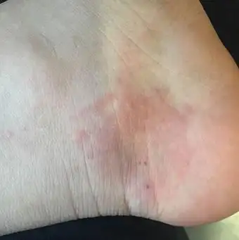 脚后跟处的湿疹图片_成都润禾皮肤病专科医院