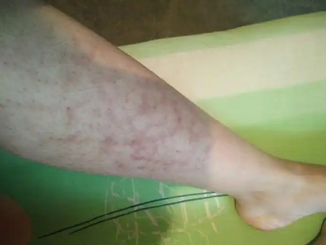 请问谁知道我这腿怎么回事,就是吃了下面这种虾,应该是过敏,当时腿很