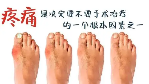 不少医生也称拇外翻为大脚骨病,对于拇外翻的治疗方案除了考虑脚趾