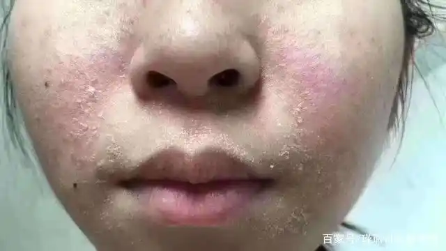 预防春敏以及换季肌肤过敏的护理方法