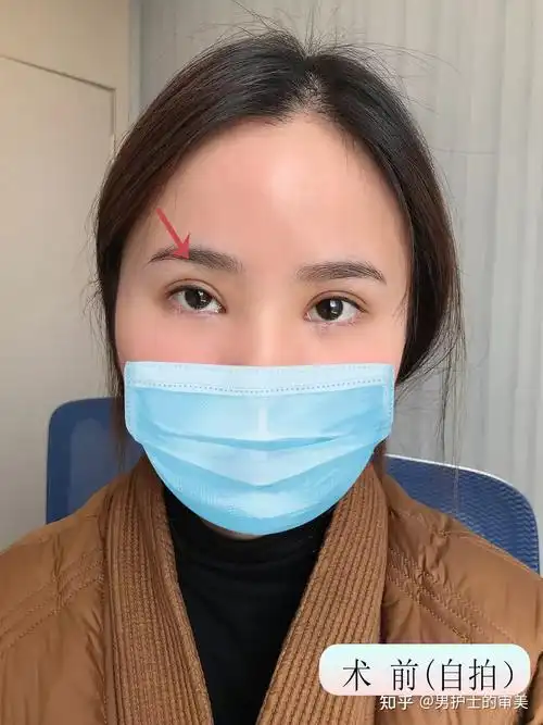 单侧上睑下垂修复3个月小姑娘双眼皮流畅眼睛对称