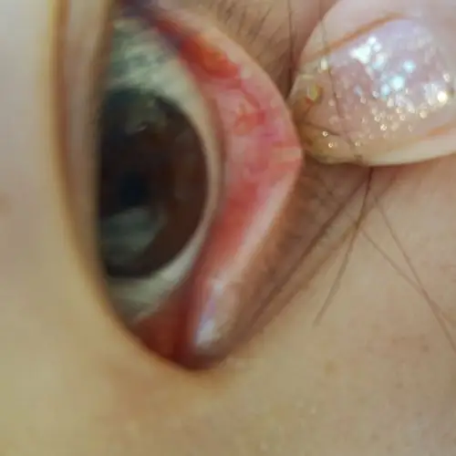 眼睛下眼睑中部长了一个白色颗粒有大半年了以为自己会好可是一直