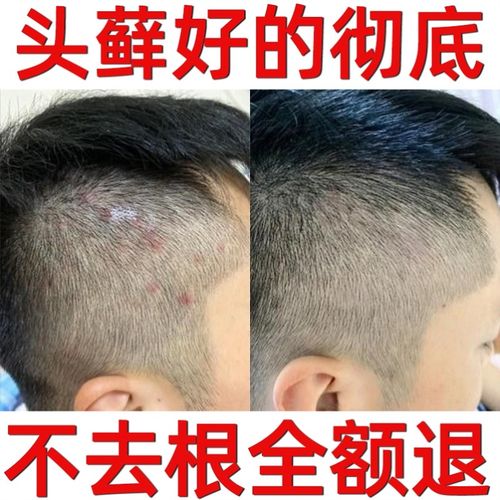 头上长痘痘毛囊炎专用药膏头部牛皮藓头痒有疙瘩头癣银屑癣洗发水