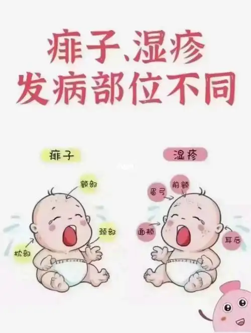 宝宝湿疹和痱子的区别