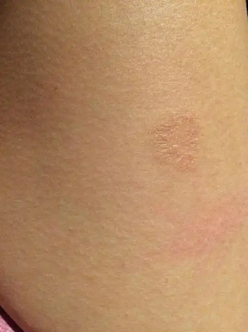 请问谁知道这是什么 是寻麻疹吗?