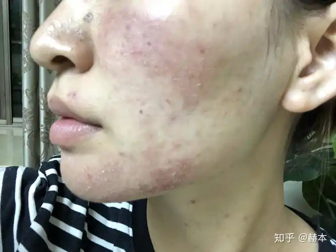 怎么看待五官漂亮但是皮肤差的女性