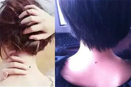 【图】脖子后面有痣代表什么 你可能需要重新认识它