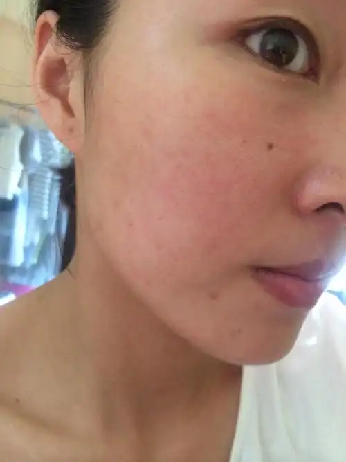 最近几个月皮肤状态很差两颊经常泛红还有时会长丘疹去二医