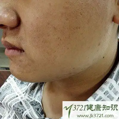 脸部过敏怎么办 男人皮肤也需细心呵护_养生美容_男士养生_健康大全