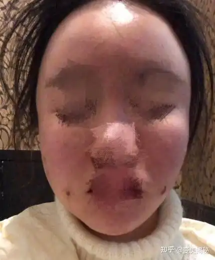 广州地区有没有做脂肪比较好的专家擅长做面部填充的医生想要自然一点