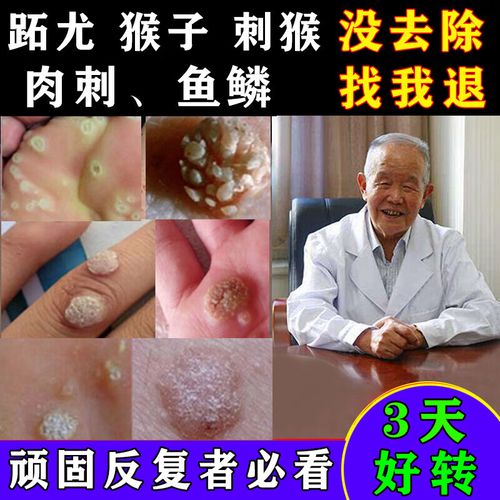 子的药肉粒疙瘩鱼鳞痣休子点瘊子痦子治肉刺去除手部 部 默认1