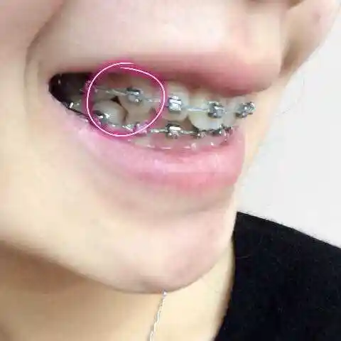 外突虎牙如何修复治疗