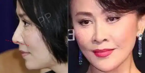就像这些年鼻子越来越翻的刘嘉玲,就是鼻翼后缩造成的牛鼻子既