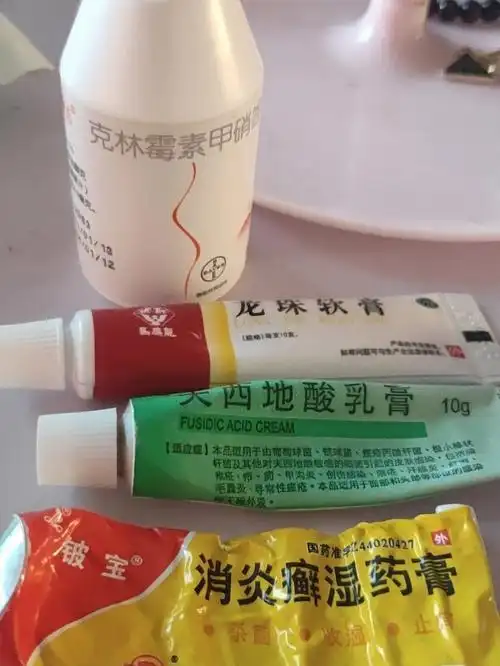 过敏性皮炎彻底治愈了