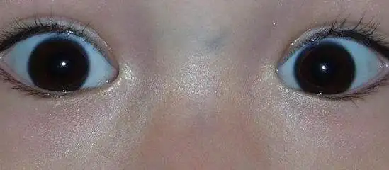 白眼球发蓝暗示贫血严重,眼睛4个症状,你中几个?