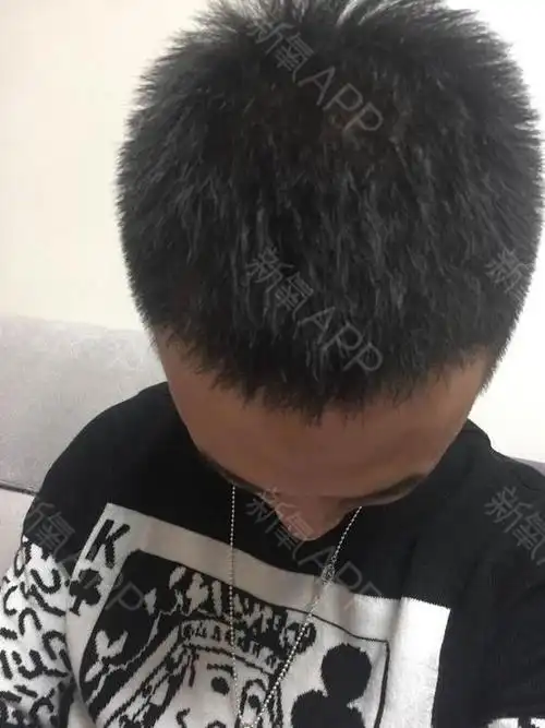 两边鬓角开始秃没了的地方现在已经没有当时的惨样,完_圈子-新氧美容