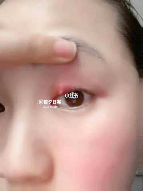 麦粒肿这样了要去医院割开放脓嘛