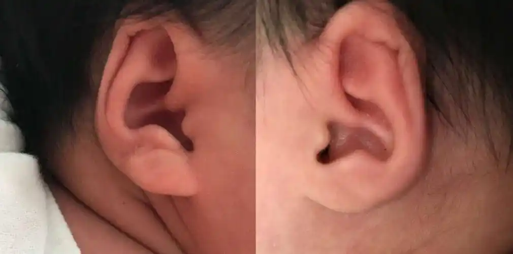 招风耳萌萌哒这几种耳廓畸形千万不能等全国爱耳日