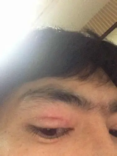 上眼睑红肿痒水泡,平均2到3天出现一次,反复的出现,大约出现一次2到3