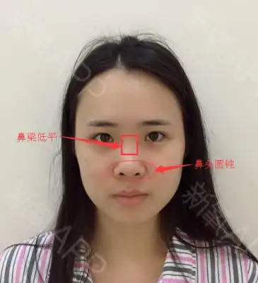 整形案例:五官不立体,鼻梁低,鼻头大怎么办?