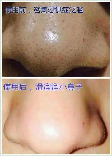 黑头星人的去黑头全过程(持续更新)