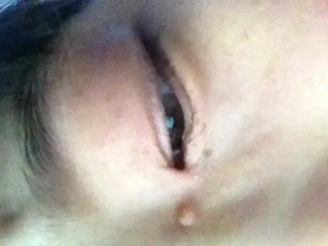 大概2013年眼睛边长了个肉瘤似的东西,不痛不痒的,特别影响