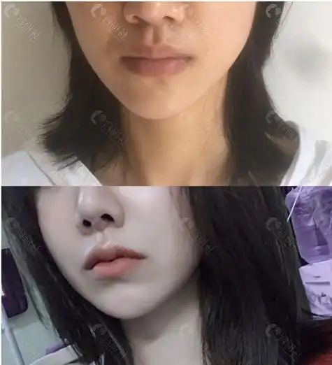 深圳福雅医疗美容胡俊杰厚唇改薄术后效果