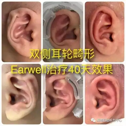 业务焦点耳鼻喉科开展新生儿耳廓无创矫形技术