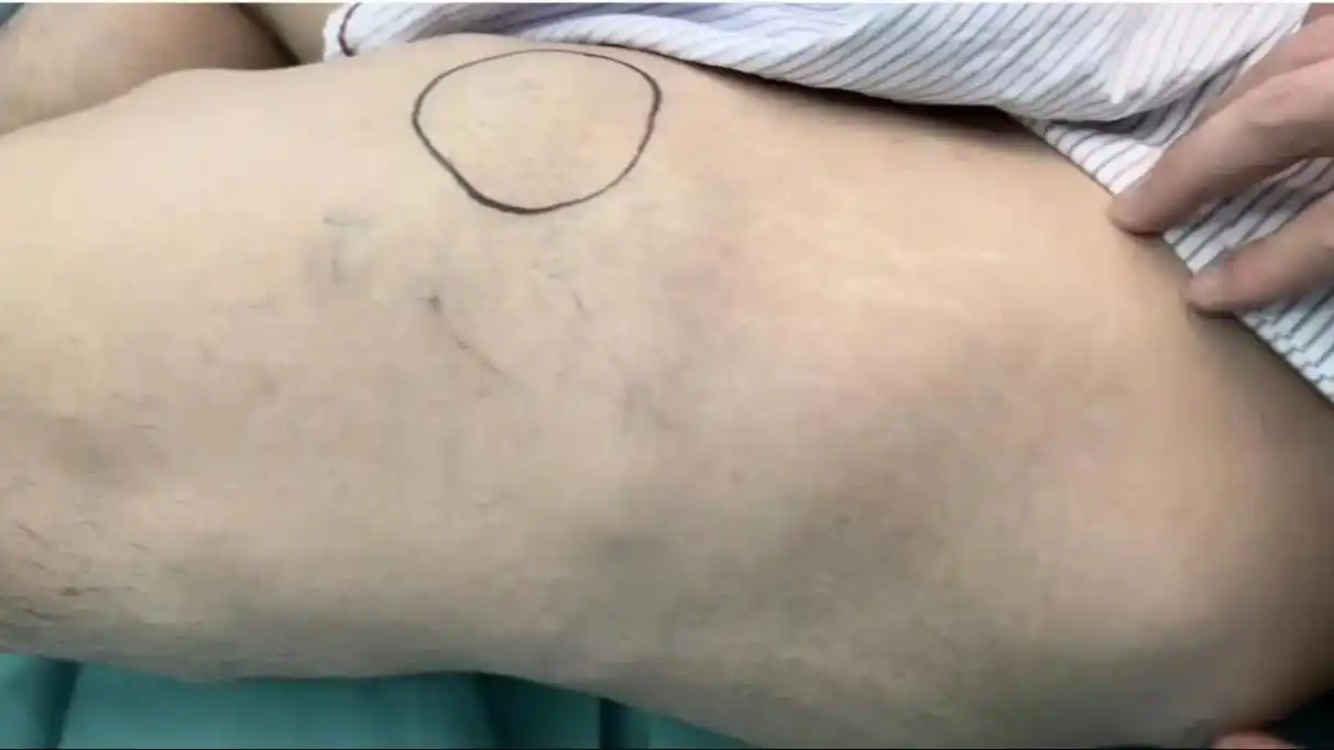 今天又切了一个大腿的多发脂肪瘤.#脂肪瘤 - 抖音