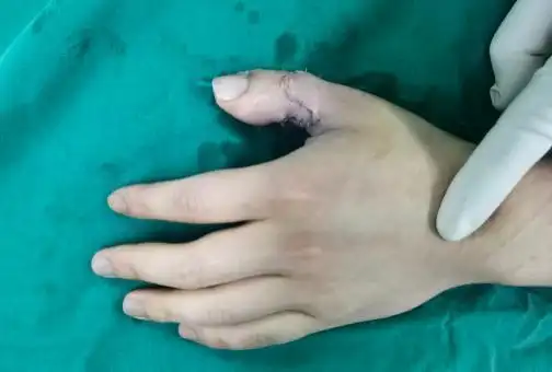 「全国手指再造医院」哪家医院手指再造好|手指再造的方式