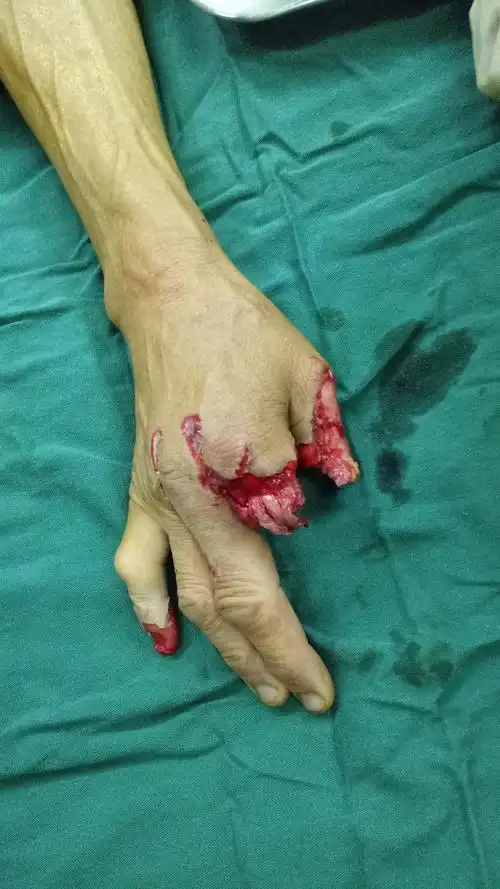 外伤手指残端情况