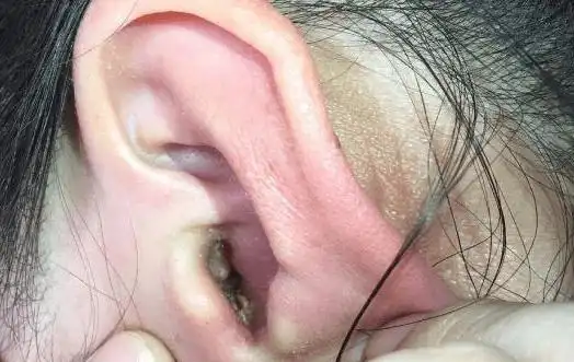 耳朵经常发痒,可能是这4种病在"作怪",不论男女,尽量别忽视_耳道_地方