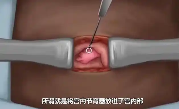 首批"上环"中老年女性3种结局:放时 "戒指",取出时"项链"