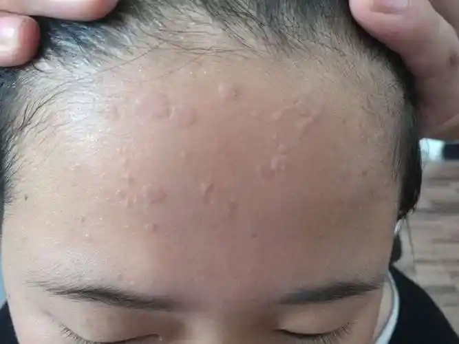 青岛金肤康皮肤病医院扁平疣怎么治疗