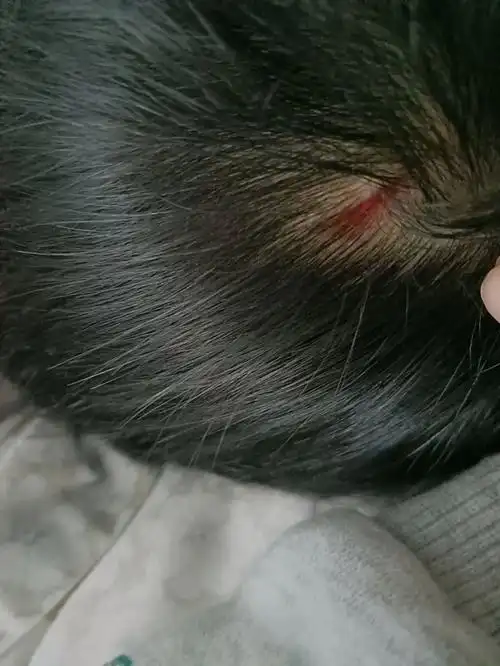 宝宝在幼儿园,头磕到柜子上了,有微微出血,需要打破伤风吗?有懂的吗?