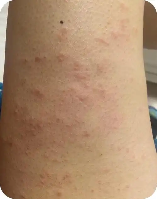 得了湿疹会传染吗?湿疹发作是怎样的体验