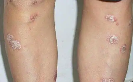 静止期的银屑病有什么症状