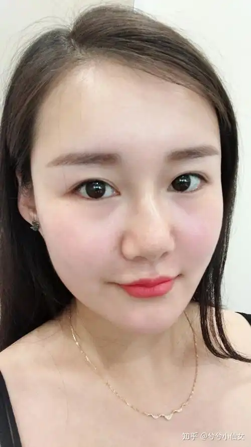 做完全脸脂肪填充后像重生了一般