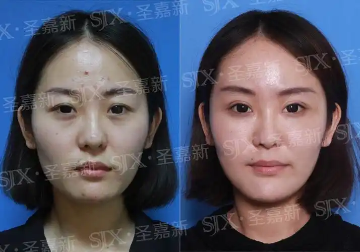 自体脂肪填充面部会不会让脸显得更大